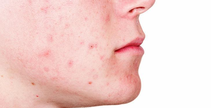 3 ürünle doğal maske! Aknelerle mücadelede yeni trend