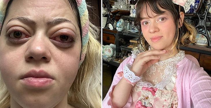 Gözleri birden bire kocaman oldu! Sebebi troid bezinde saklıymış