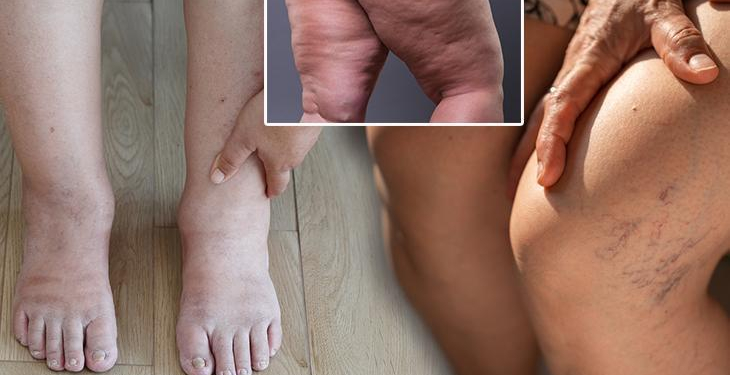 Kilo değil hastalık! Bu hatalar bacaklarda dolaşımı bozuyor