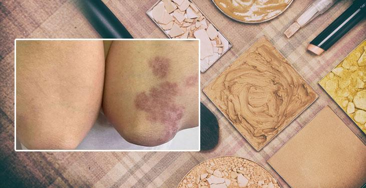 Popüler makyaj trendi ölümüne sebep oluyordu! Tüm vücudunu sardı