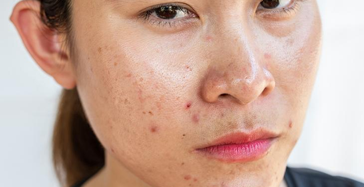 Pürüzsüz bir cilt için hormonal denge! Uzmanından tavsiyeler